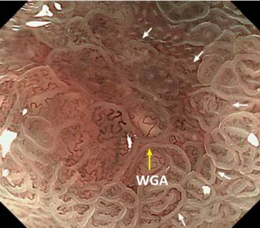 内镜检查痛苦吗,内镜检查是怎么做的
