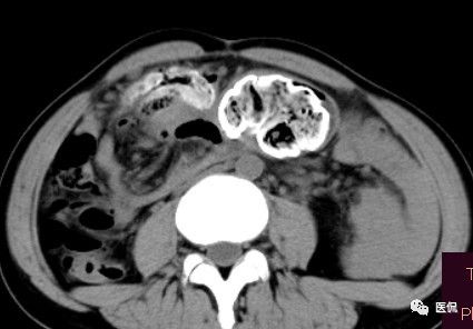 手术纱布遗留在体内可以吸收吗,手术纱布忘了取出会怎样