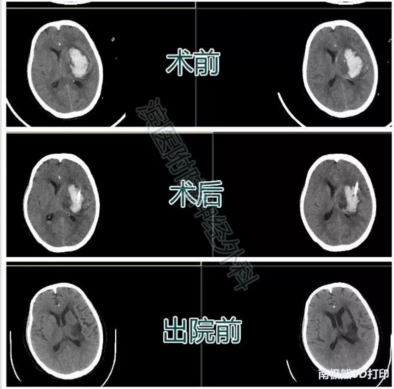 3D打印在脑出血治疗中的应用
