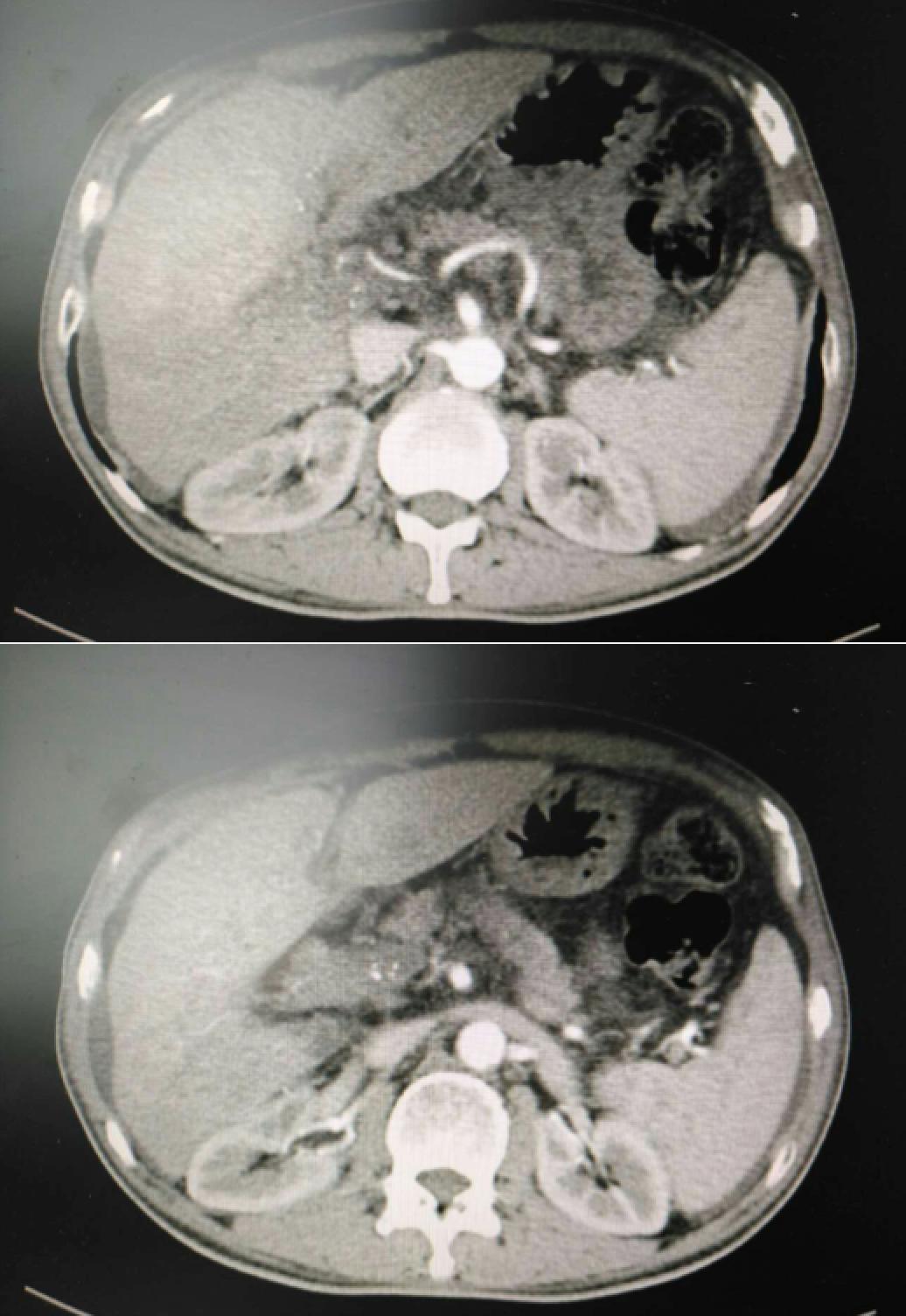 周仲国评价肝癌病例,周仲国分享肝癌早期复发