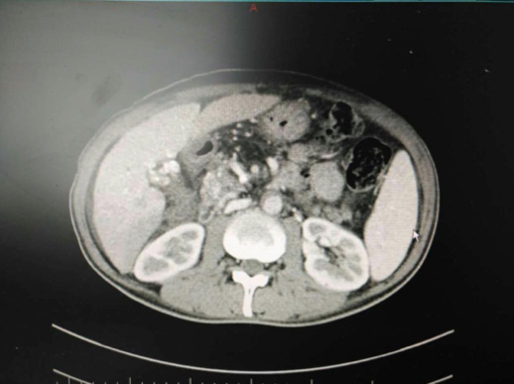 肝癌病例实例100例,肝癌的治疗方法论文