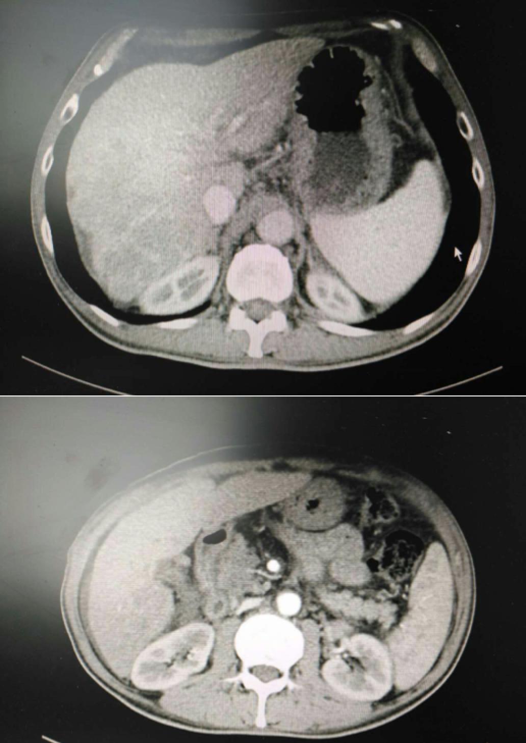 肝癌病例实例100例,肝癌的治疗方法论文