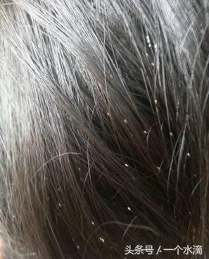 你对虱子和虮子只停留在上世纪六七十年代吗?国外现在还有