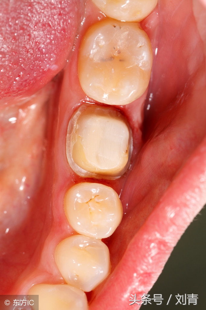 根管治疗真的有必要做吗,根管治疗真的有必要吗