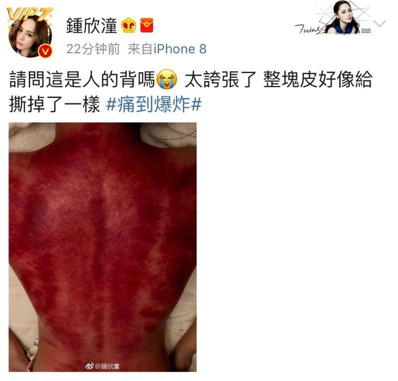 阿娇刮痧,阿娇背部刮痧图片