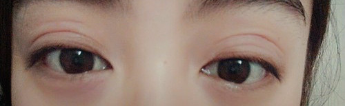 割双眼皮变成三眼皮如何修复,双眼皮修复完变三眼皮