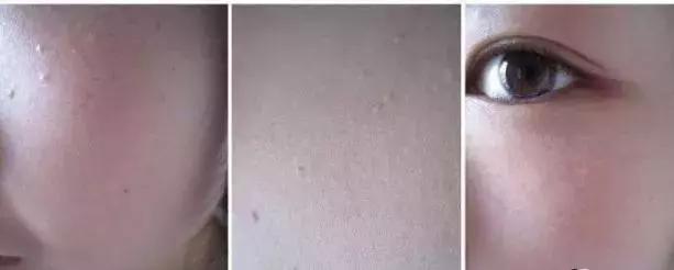 不用针挑刺,不用针挑刺还有什么办法能挑