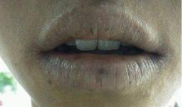 怎么才能消除唇炎,唇炎怎么快速消除小窍门视频