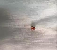 反复咳嗽、支气管炎老不好?当心异物在作祟