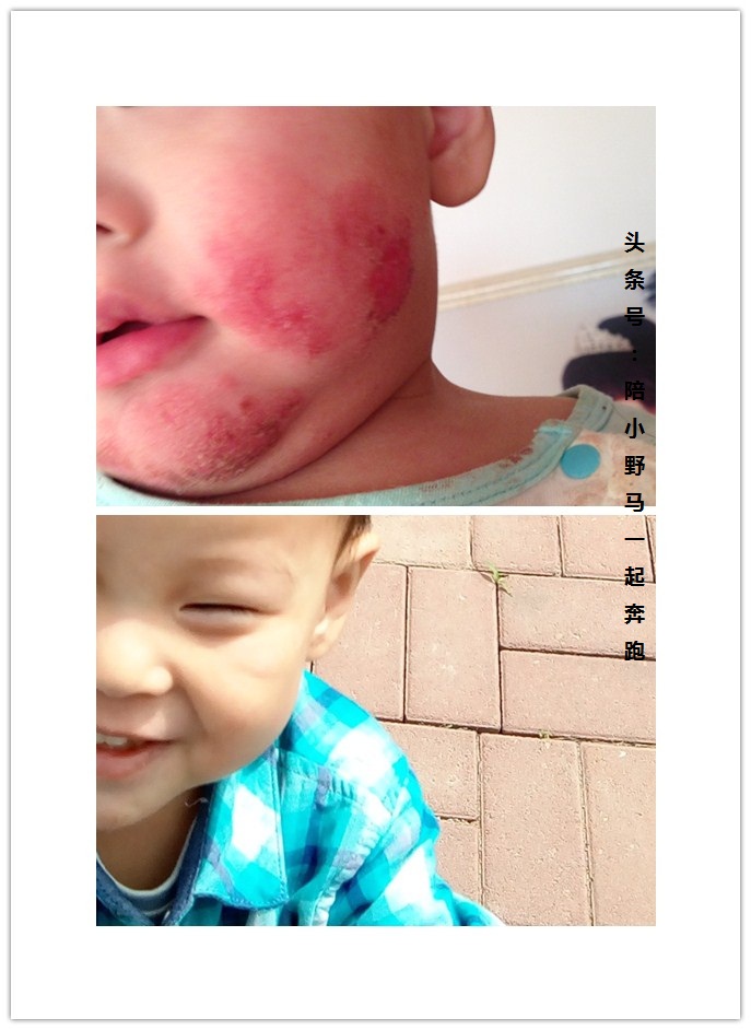 与湿疹抗战三载，四个湿疹“后遗症”并没想象中那么可怕