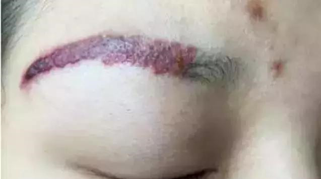 怎么让眉毛快速结痂掉痂,眉毛结痂掉痂修复过程