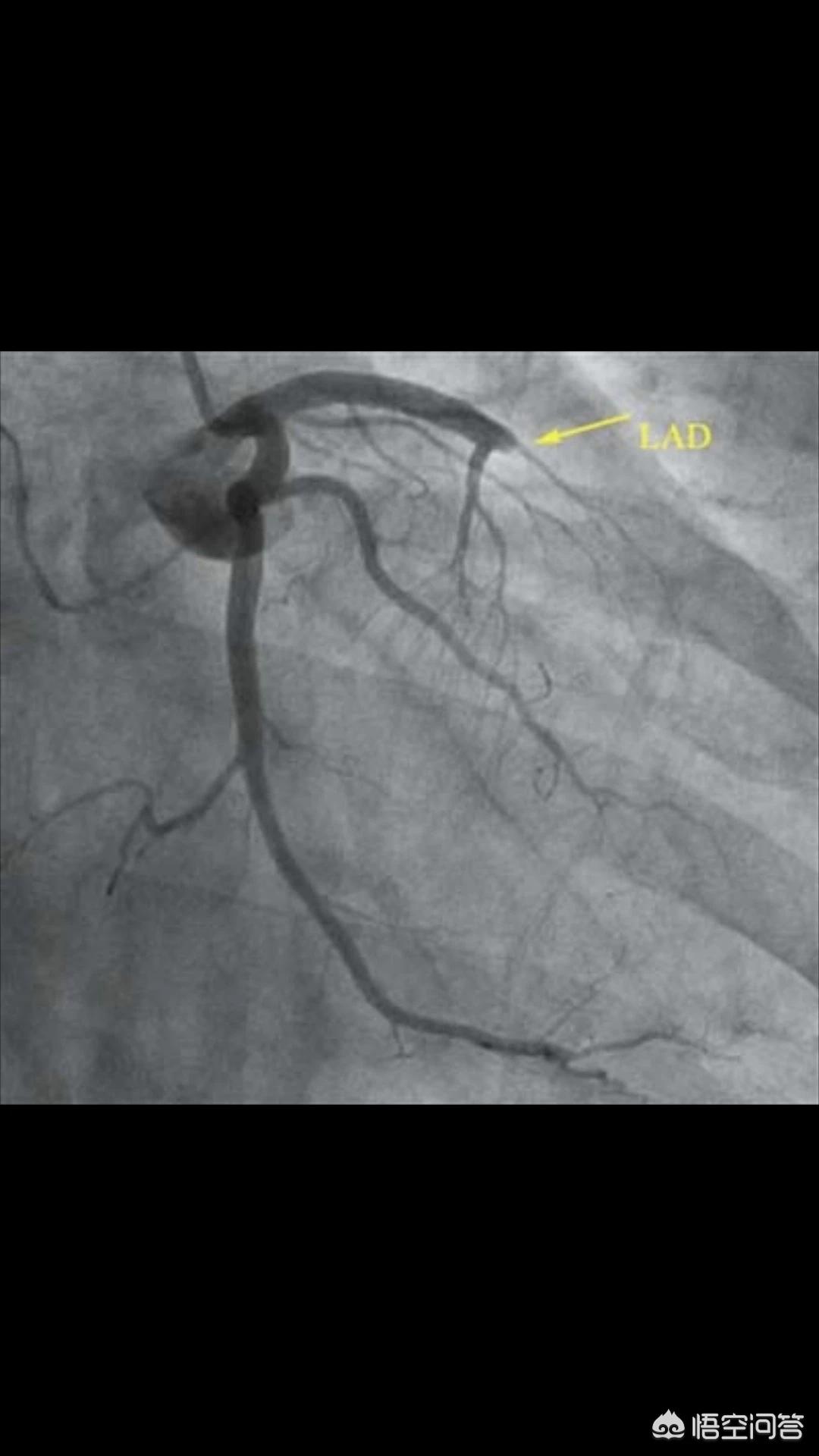 心脏有三根大血管,堵死一根还能正常工作吗?