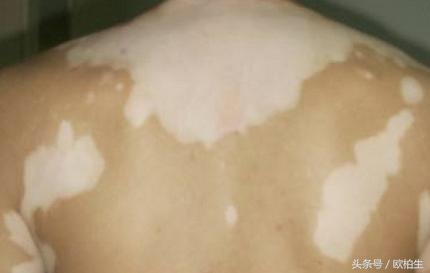 sc5b型紫外线光疗仪怎么样,紫外线光疗仪和308激光哪个好