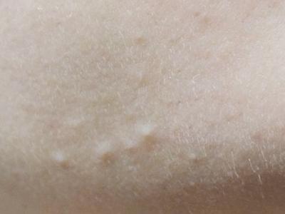 黑头粉刺闭口白头毛孔粗大,怎么区分黑头白头粉刺闭口