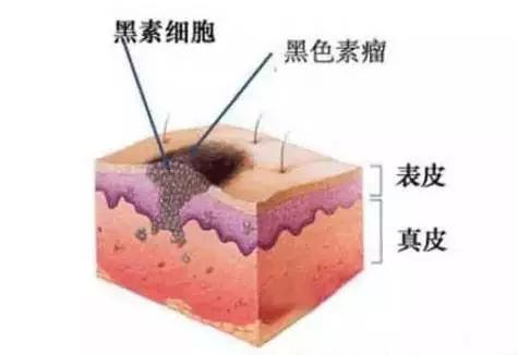 脸上长斑点痣,脸上长痣用药去好还是激光去好