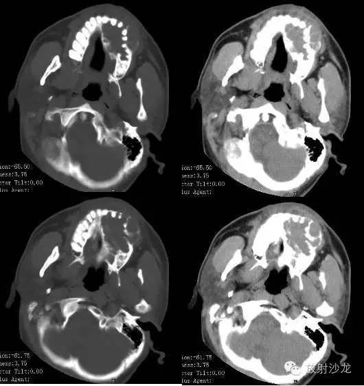 巨细胞性肉芽肿治疗费用,颌骨巨细胞修复性肉芽肿x线表现