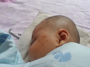 青春痘经常被家长忽视,一岁半宝宝长青春痘