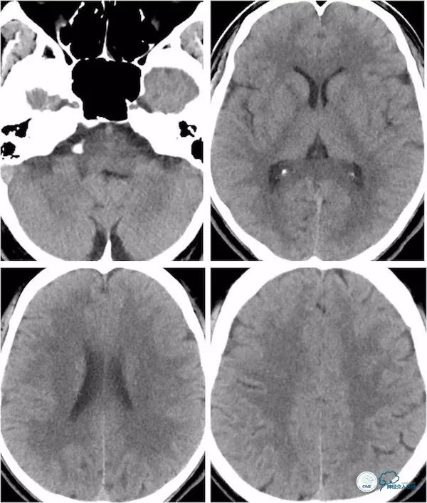 天坛医院做椎动脉狭窄多少要手术,天坛椎动脉狭窄