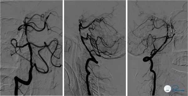 天坛医院做椎动脉狭窄多少要手术,天坛椎动脉狭窄
