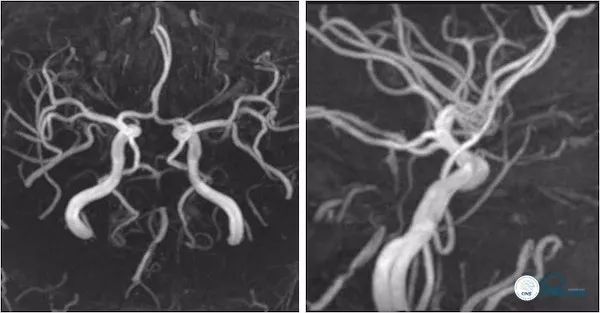 天坛医院做椎动脉狭窄多少要手术,天坛椎动脉狭窄