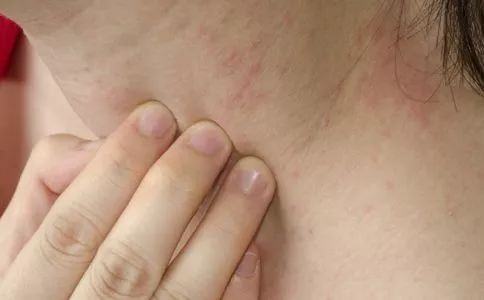 湿疹痒痒用什么药膏,湿疹西医和中医一起治会效果好吗