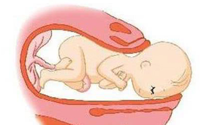 凶险性前置胎盘有多危险看一看吧,前置胎盘的预防方法和护理方法