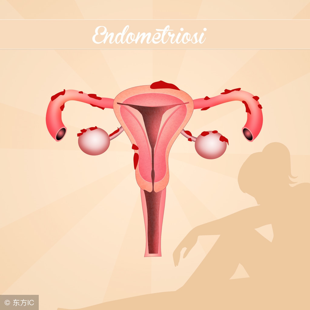 剖腹产子宫脱垂自愈最佳方法,分娩子宫脱垂