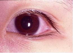 红眼痛怎么回事,不疼不痒眼睛肿是怎么回事