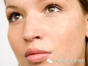 脸上长雀斑是什么原因男生,脸上长雀斑和黄褐斑怎么办