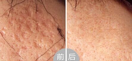 脸上的痘坑怎么修复啊,脸上的痘坑怎么修复呀