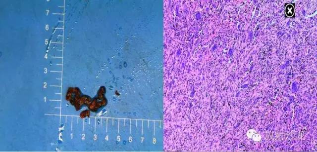巨细胞性肉芽肿治疗费用,颌骨巨细胞修复性肉芽肿x线表现