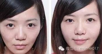 脸上部分凹陷,年龄增长脸颊凹陷