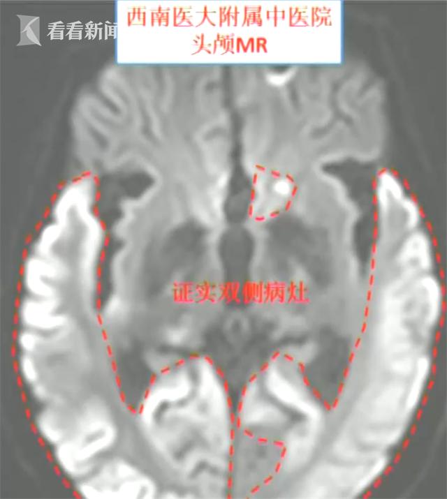 六旬大爷患罕见病却遇药品紧缺医生让他喝红牛