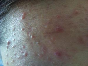 青春期额头上长痘痘是什么原因,30多岁额头长痘痘是什么原因