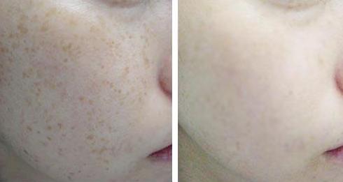 祛斑最有效的方法在家就能做,白云山祛斑面膜真的祛斑吗