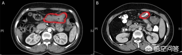 放疗与化疗不同之处,化疗与放疗的区别和优缺点