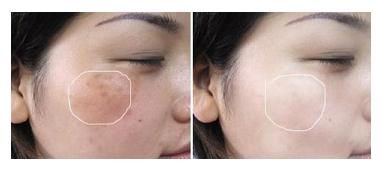 祛斑祛不干净怎么回事,祛斑不正确的方法