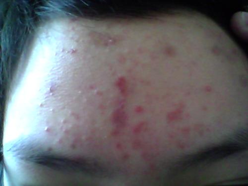 八岁女孩额头上长痘痘什么原因,孕期额头上长痘痘是什么原因