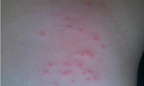 小孩吃药过敏最简单的处理方法,小孩吃药过敏最快解决方法