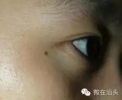 点痣会引发痣癌变吗,痣旁边长了小痣是不是癌变