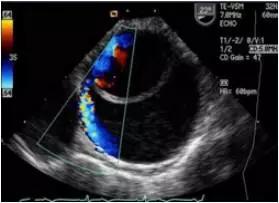 主动脉夹层动脉瘤如何检查和防治,主动脉夹层动脉瘤的超声表现