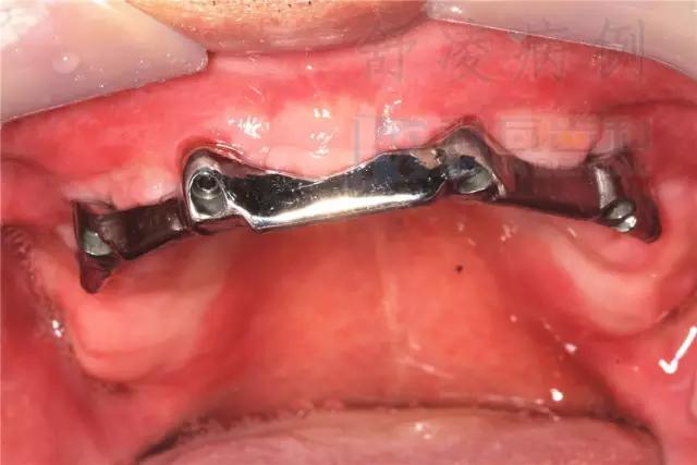 活动假牙戴不住，种植牙又嫌贵该怎么办？