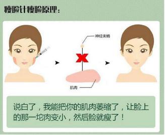 关于瘦脸针的几个常识问题,解密瘦脸针的几大常识性问题