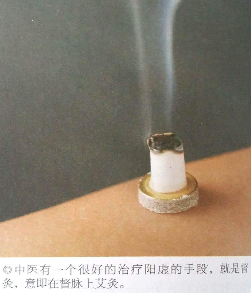 灸督脉,治疗阳虚不用吃药