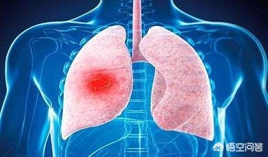 肺癌治疗为什么要做基因检测,肺癌基因检测和精准医疗