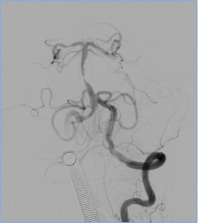 缺血性脑卒中术后管理,急性缺血性脑卒中血管内治疗