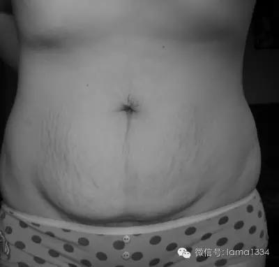 生产后肚皮褶皱松垮视频,产后减肥后肚皮松垮皱巴巴