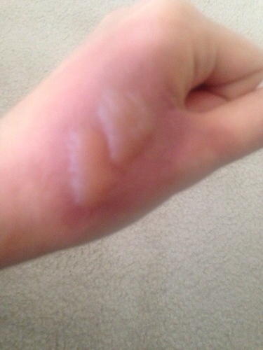 不小心被开水烫到起了皮怎么处理,不小心被开水烫了能用冷水冲吗