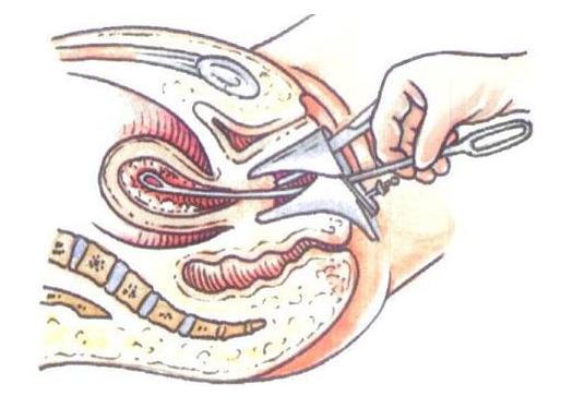 取环详细手术记录,取环术手术步骤