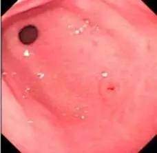 老年人慢性胃炎吃什么中成药,老年人慢性胃炎怎么治疗好得快